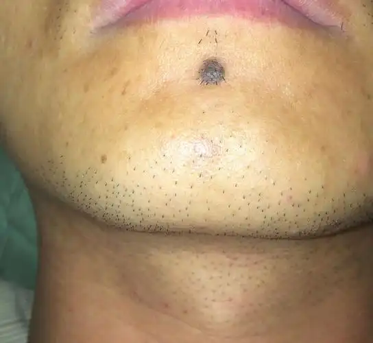 下巴正中间痣能去吗?
