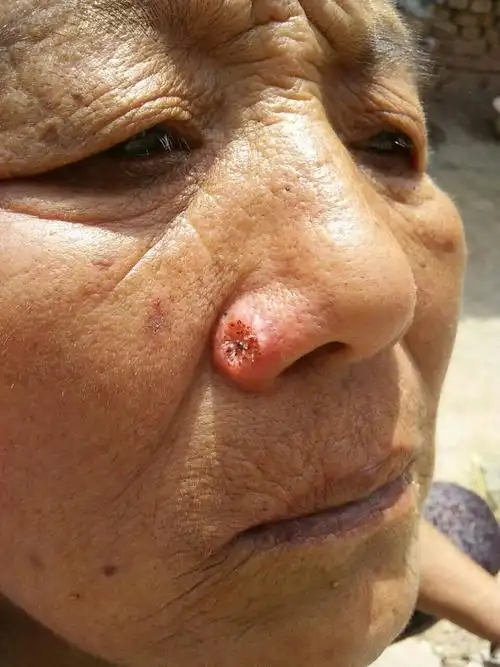 3个月前长的像粉刺一样的疙瘩,动了一次手术后,5