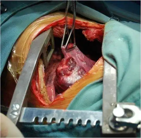 单孔胸腔镜微创技术-胸外科微创化手术操作的极致!