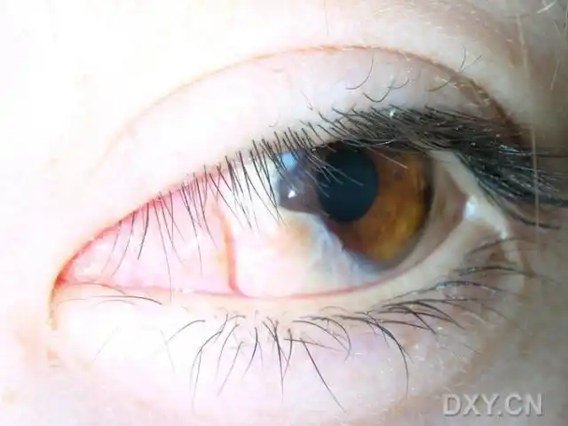 【分享】结膜肿物