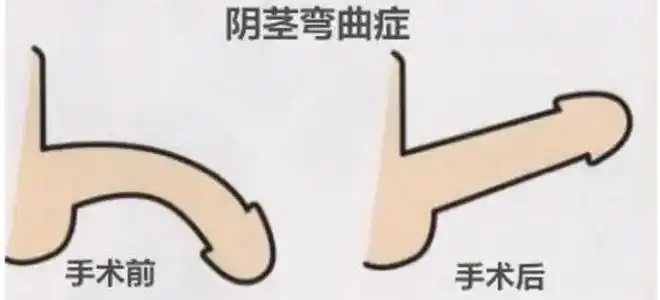 十个男人九个弯你以为男人丁丁应该是笔直的吗