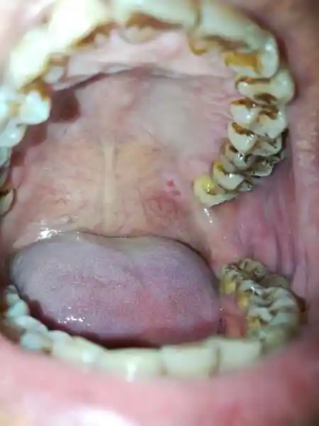 上颚长了一个疙瘩,不会痛,也不影响吃饭那些,请问这是口腔癌前病变吗?