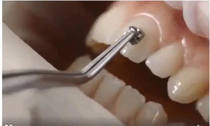 牙套是怎么粘在牙齿上的粘牙套的全过程