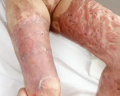 人工真皮植入——一种新的手术方治疗儿童烧伤疤痕增生的方法_疤痕