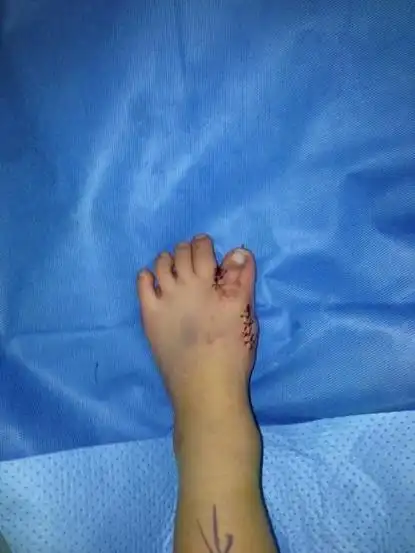 胡一刀告诉你儿童脚趾畸形怎么办