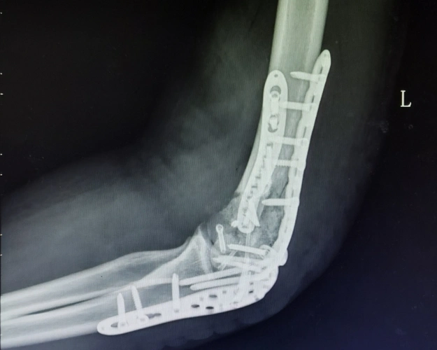 成人肱骨远端骨折分为高能量损伤骨折和低能量损伤骨折.