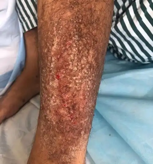 确诊患有皮肤淀粉样变张先生到我院皮肤科就诊后痛痒得他恨不得用刀割