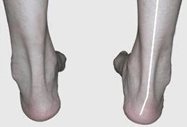 如何辨别足内翻还是足外翻--东一健身教练培训学院