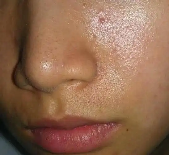 8,1首先要去除螨虫的传染源,包括不要与脸上有螨虫的人直接接触家里最