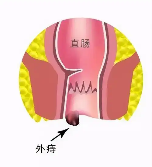 痔疮长什么样子的图片 痔疮什么样子图片初期-快经验