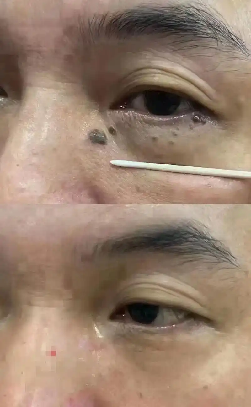 92疣类知识: 疣性状:传染性! 初期约1-3年为近肤色,  - 抖音