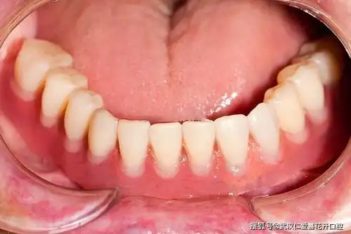 曾经不止有一,两个人问过小编这样的问题,很多人在咨询其它牙齿问题时