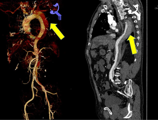 微创治疗—主动脉夹层 - 好大夫在线
