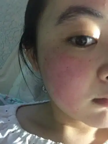 因为在朋友家住,用了朋友的化妆品,皮肤出现小面积红 肿,怀疑是过敏