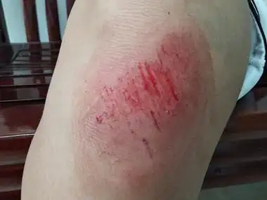 跌伤膝盖皮肤肿胀及多处擦伤裂口图