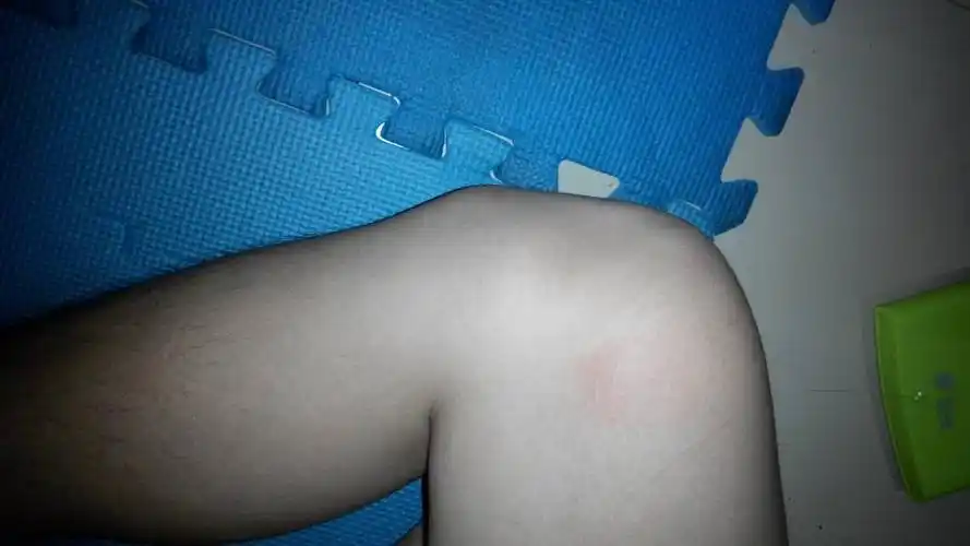 问:一只膝盖下的骨头长得突出 14岁左右就长了 无不适感 不影响生活