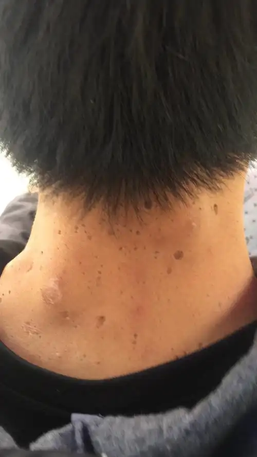 这是什么,上面全是很大的洞,还有很大的包,超级恶心,感觉里面烂了这