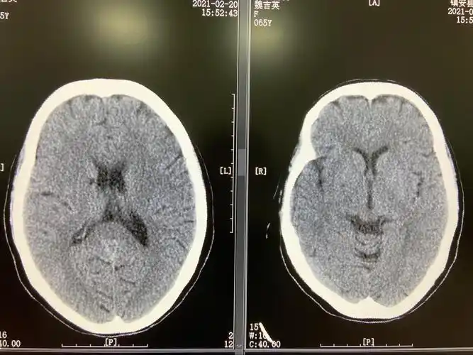 病例2:患者头疼,头晕就诊,既往有脑梗塞病史,ct平扫仅显示右侧基底节