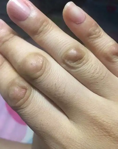 患有指节垫等皮肤病:手足指(趾)间关节的伸侧出现扁平或隆起的局限性