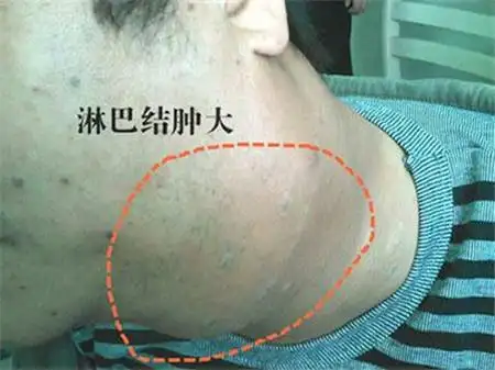 恶性淋巴瘤的早期症状有哪些?如何正确治疗?