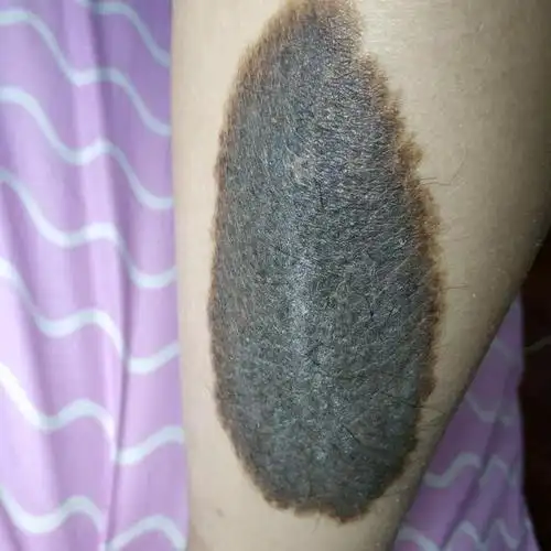 黑猫遮盖胎记,终于可以穿裙子了 这个黑色的胎记困扰了美女22年,她