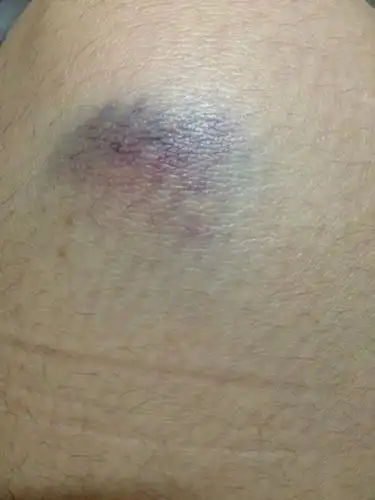 医生麻烦看下 膝盖上的按下有痛 是普通淤青吗?