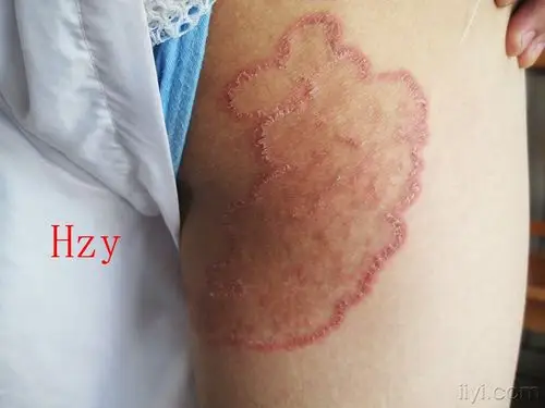 公布答案:股癣.