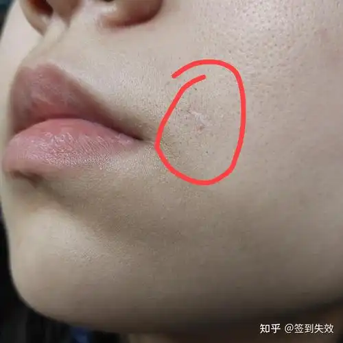 我的手术切痣77激光点痣记录