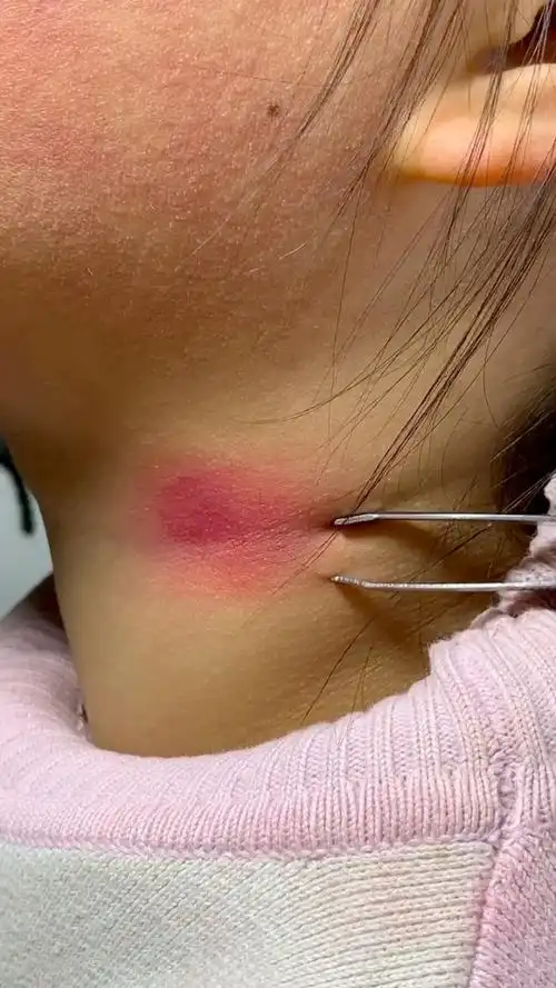 脖子上被男朋友种下的草莓出门很尴尬91可以这样解决