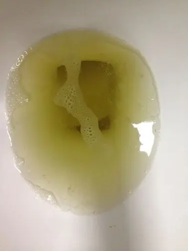 谁懂谁懂医帮忙看看有没有问题,感觉沫子很多,表面很黏的.