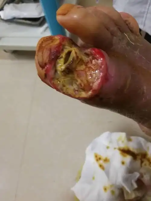 这是第二个患者的脚趾部,坏疽,部分还有感染