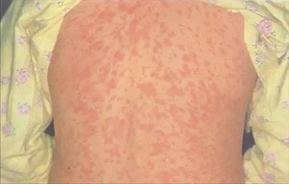 认识常见的的药物性皮炎——药疹|皮疹|镇痛药_网易订阅