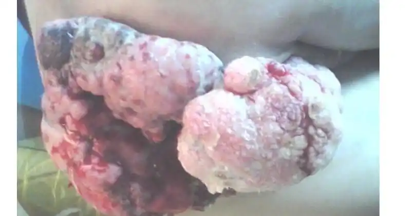 肛门疣扁平疣图片_有来医生