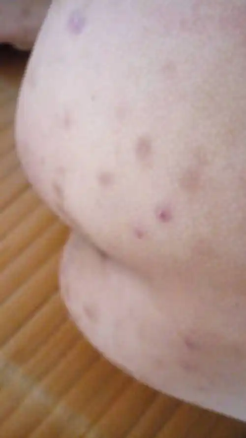 问:求医生解答,每年夏天就会长这样的包,然后会留下很难看的痕迹,屁股