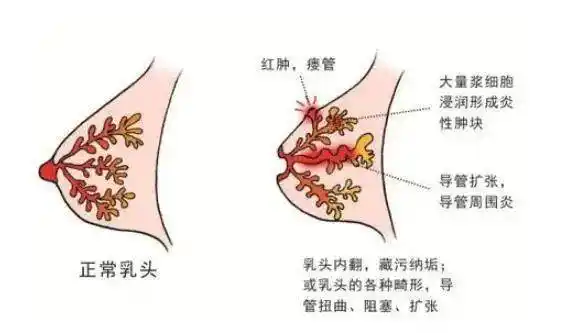 有种"难缠"的乳腺疾病青睐中青年女性_治疗_肿块_乳房