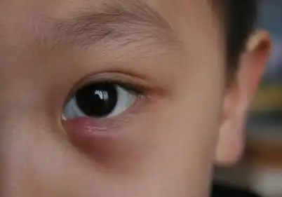 麦粒肿怎么治疗麦粒肿有哪些症状麦粒肿治疗方法