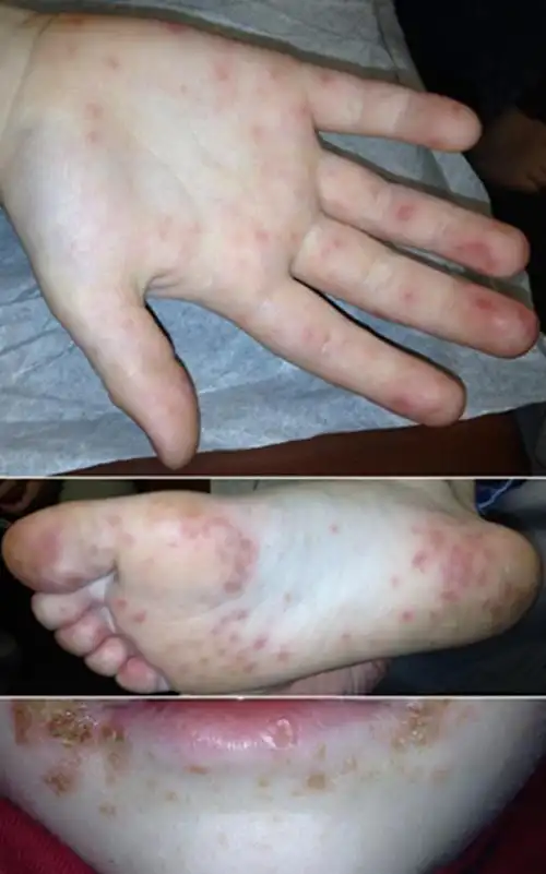 大人手足口病初期症状图