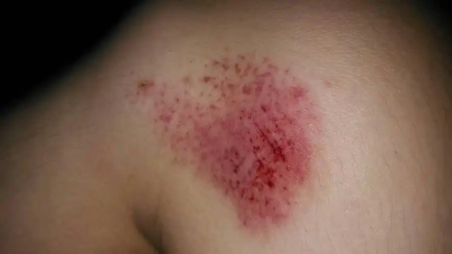 右腿左侧膝盖,打球时候摔倒蹭破的,怎么处理,有点火辣辣的疼