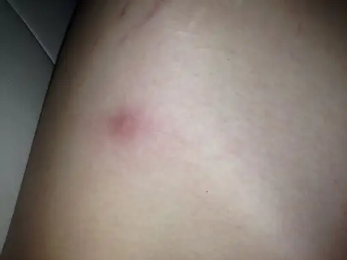 问:肩膀上起了个红包,硬邦邦的挤不破,摸着疼.这是什么包.怎么消除.