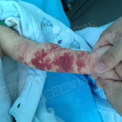 来自赵泽左侧腋下上肢婴幼儿血管瘤患者日记