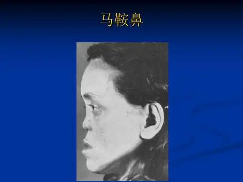 青霉素未发明前,为何会有"马鞍鼻人"的存在?