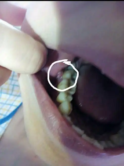 口腔长了一个小肉球,不知道是什么,请大家来看看,急急急!