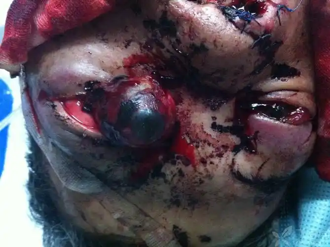 眼科 眼眶病/眼整形 帖子详情发布于 2013-11-27 回复 收藏 1