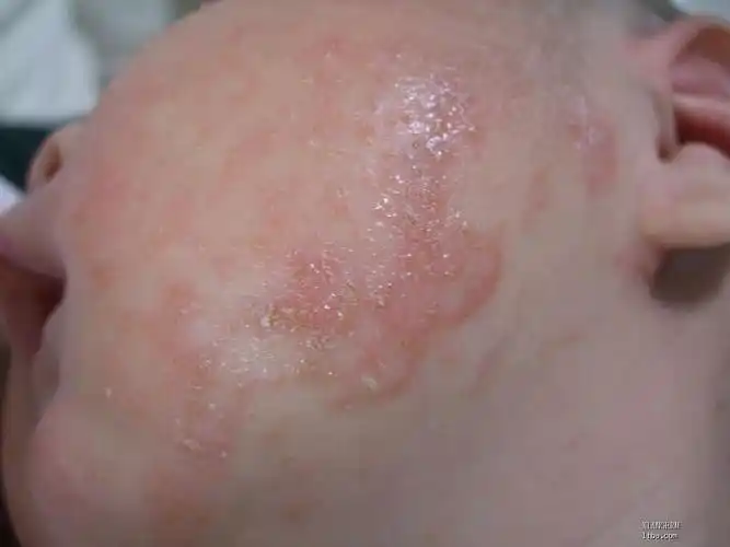 婴儿湿疹是小孩子非常常见的一种皮肤病,以前经常从医生的角度上指导