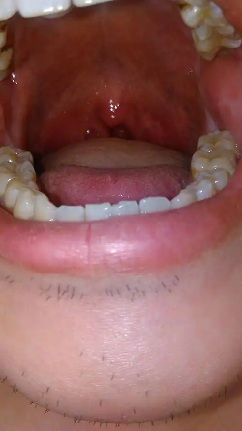 小舌头下方两发隆起的是什么呀