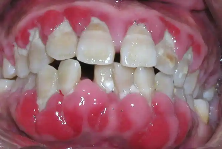 医源性牙周病表现在哪几个方面