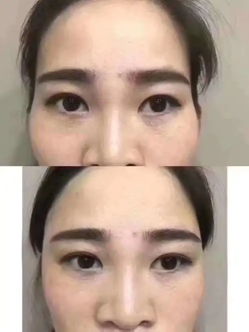 太阳穴泪沟填充对比