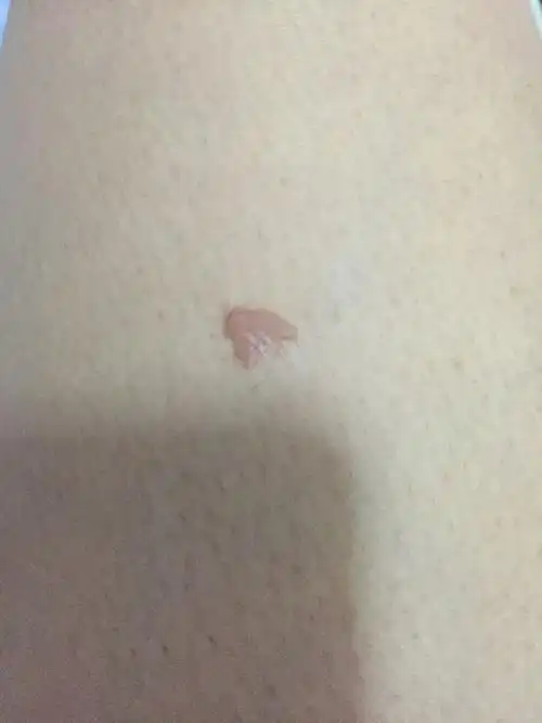 大腿上的是寻常疣么?_百度知道