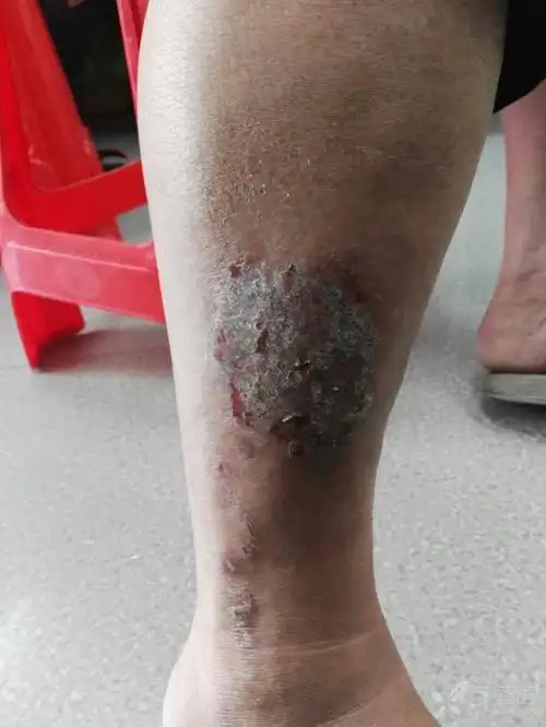 双小腿外侧皮疹,溃疡10年,考虑什么? [病例帖]