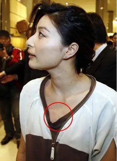 阿娇晒刮痧照香肩玉背荡然无存,李冰冰贾乃亮等也曾带"痧"出镜